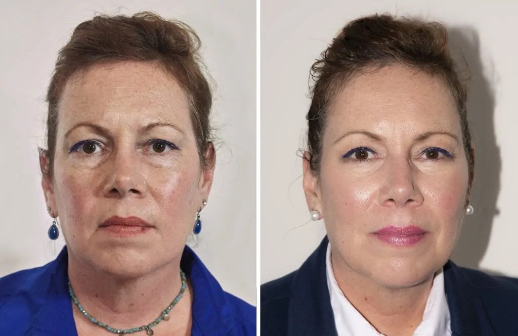 Before & After 1